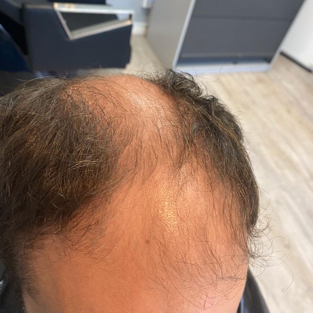 Hair Rejuvenation Clinic UK