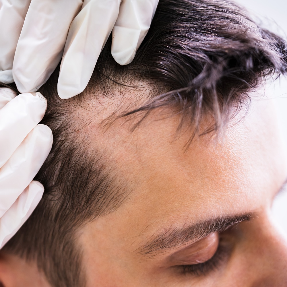 Hair Replacement Systems for men